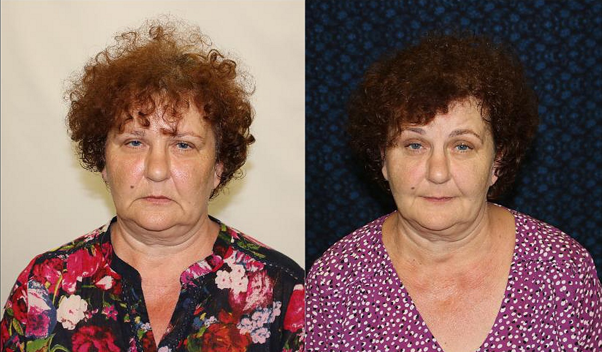 Obličejová jóga po 40 dnech cvičení